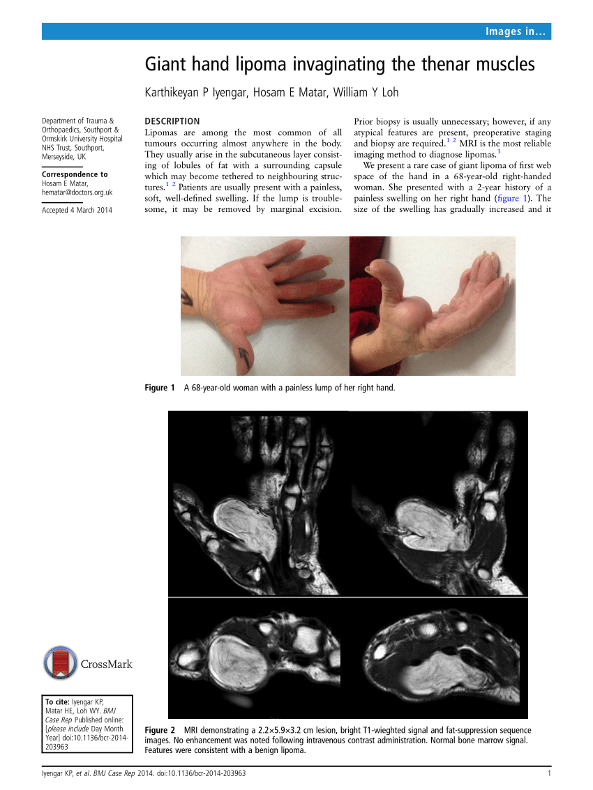 Pdf Giant Hand Lipoma Invaginating The Thenar Muscles 