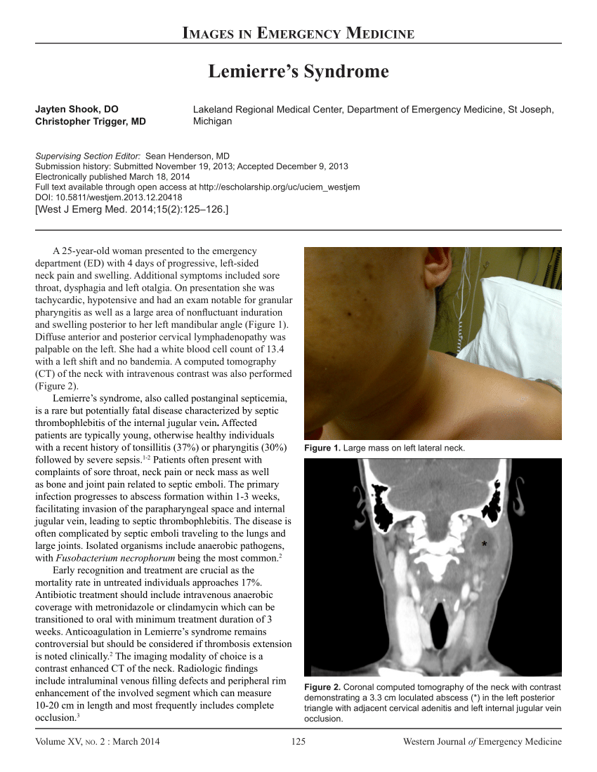 (PDF) Lemierre’s Syndrome
