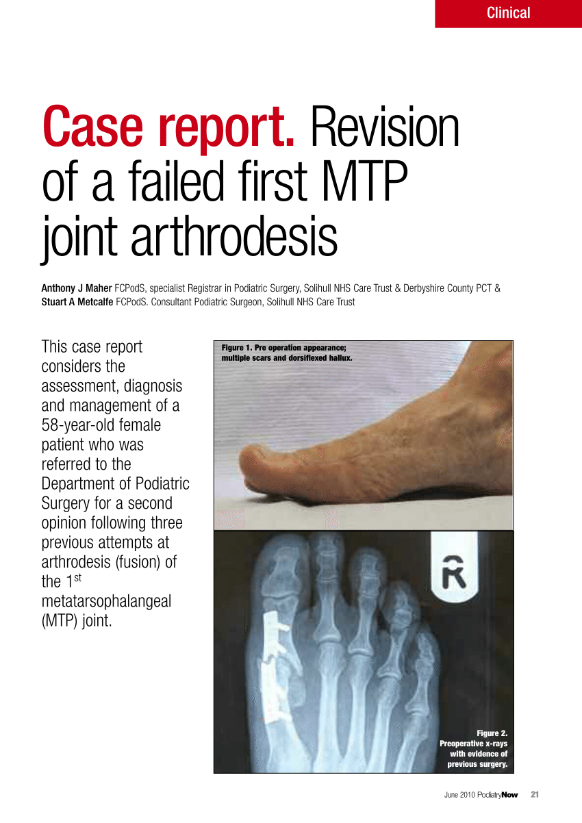 first metatarsophalangeal joint osteoarthritis treatment