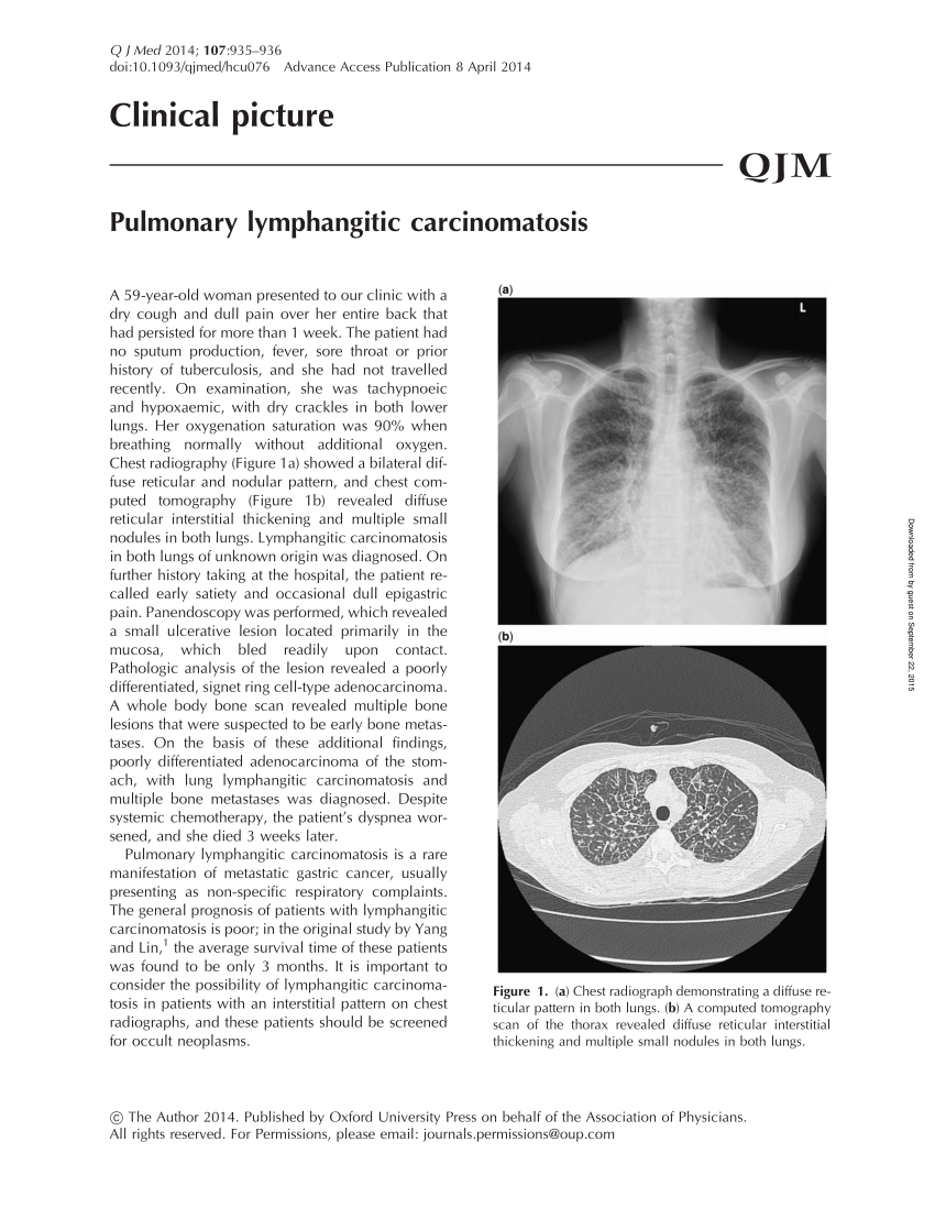 Pdf Pulmonary Lymphangitic Carcinomatosis 