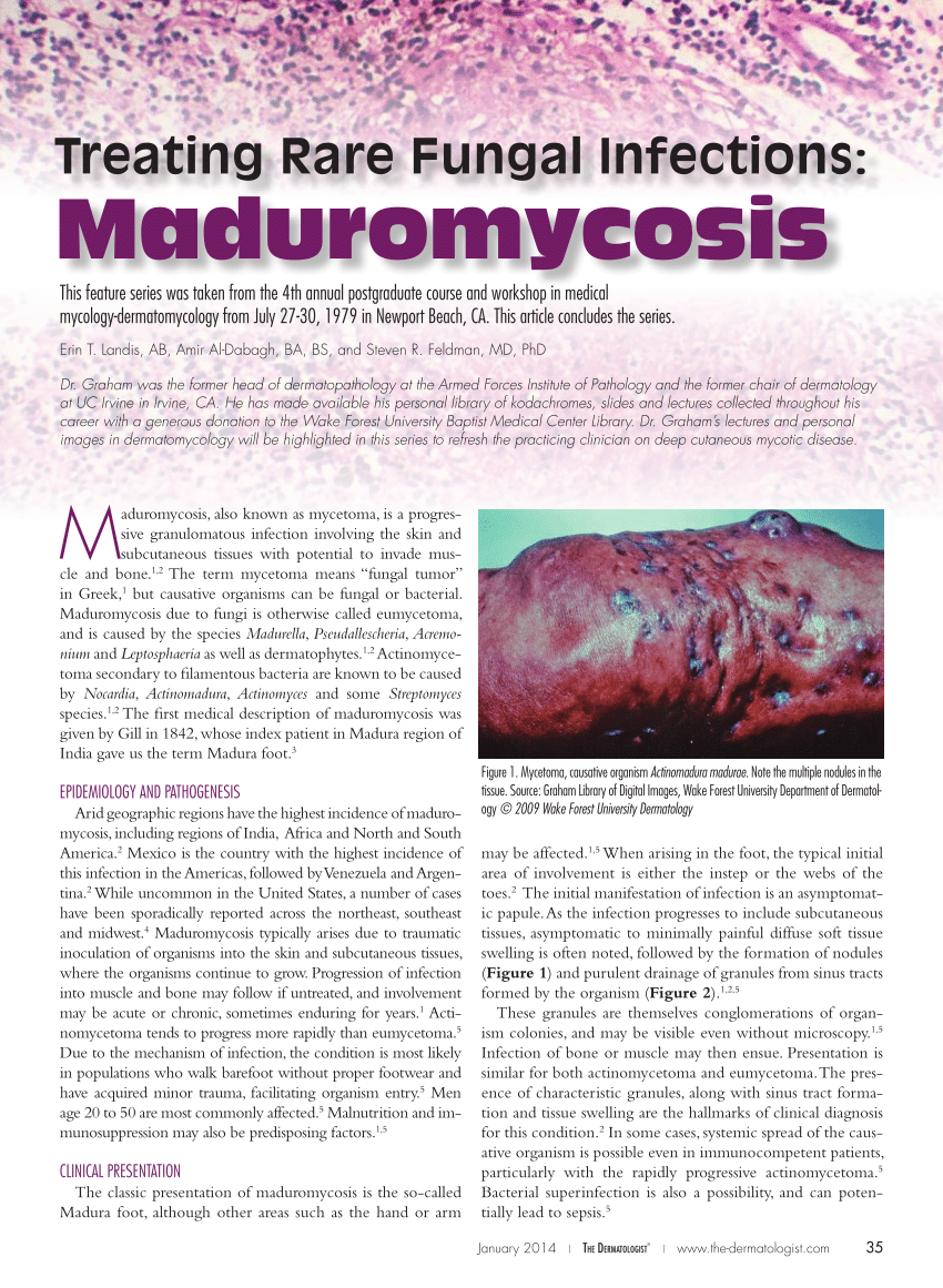 (PDF) Treating Rare Fungal Infections Maduromycosis