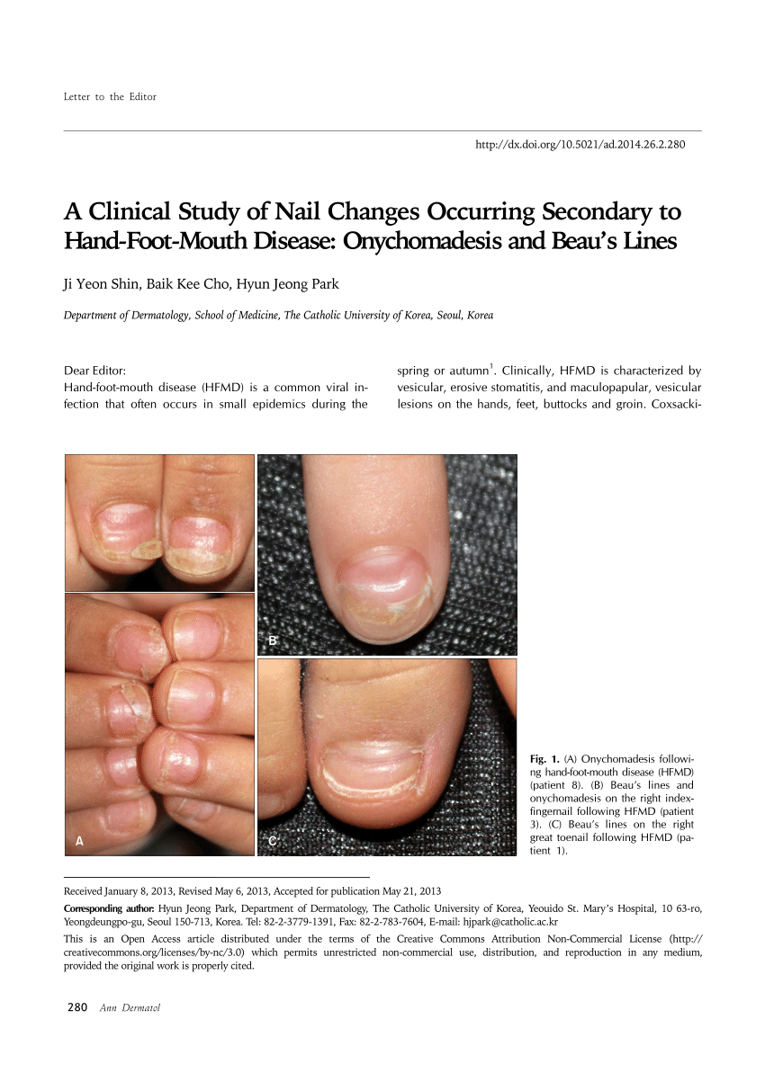 Unilateral Beau's lines in a case of complex regional pain syndrome (reflex  sympathetic dystrophy) - Indian Journal of Dermatology, Venereology and  Leprology