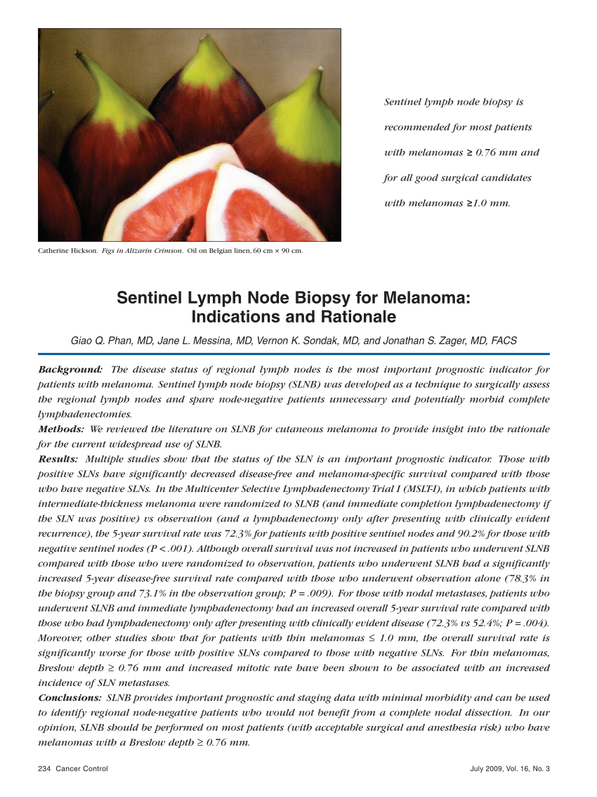 sentinel node biopsy malignant melanoma