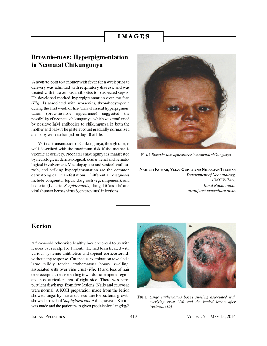 (PDF) Brownie-nose: Hyperpigmentation in Neonatal Chikungunya