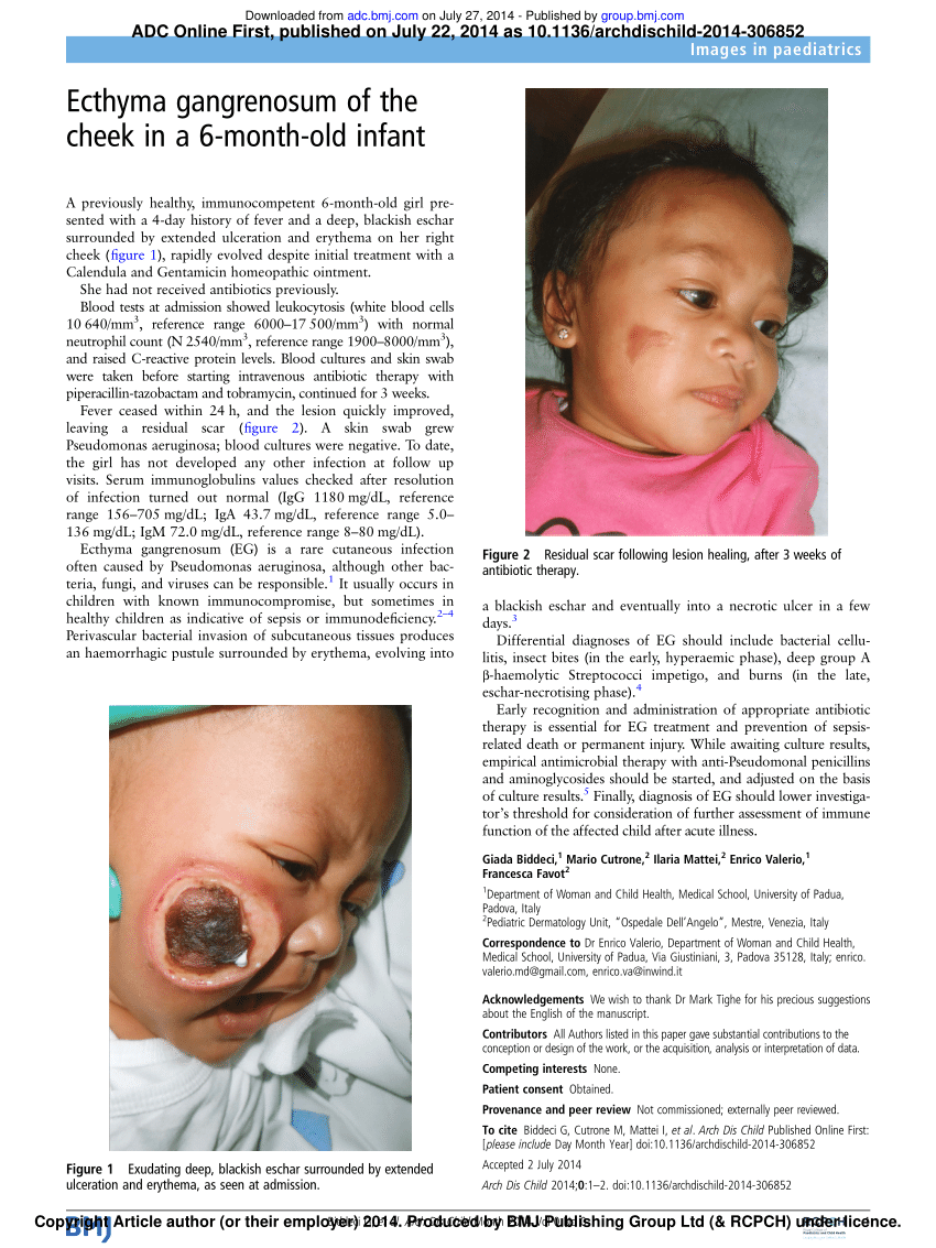Pdf Images In Paediatrics Ecthyma Gangrenosum Of The Cheek In A 6