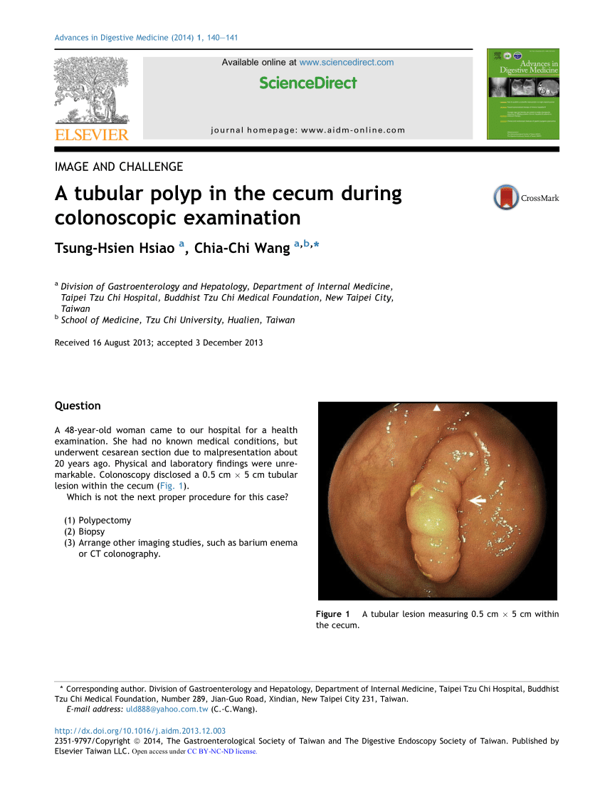 Pdf A Tubular Polyp In The Cecum During Colonoscopic Examination