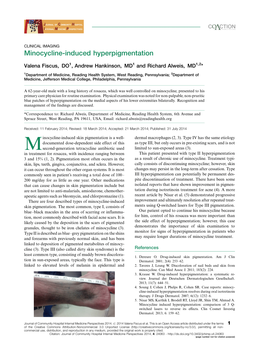 Pdf Minocycline Induced Hyperpigmentation