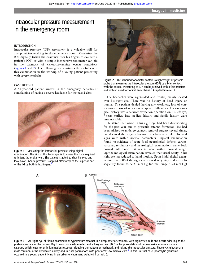 Measuring Eye Pressure (IOP)