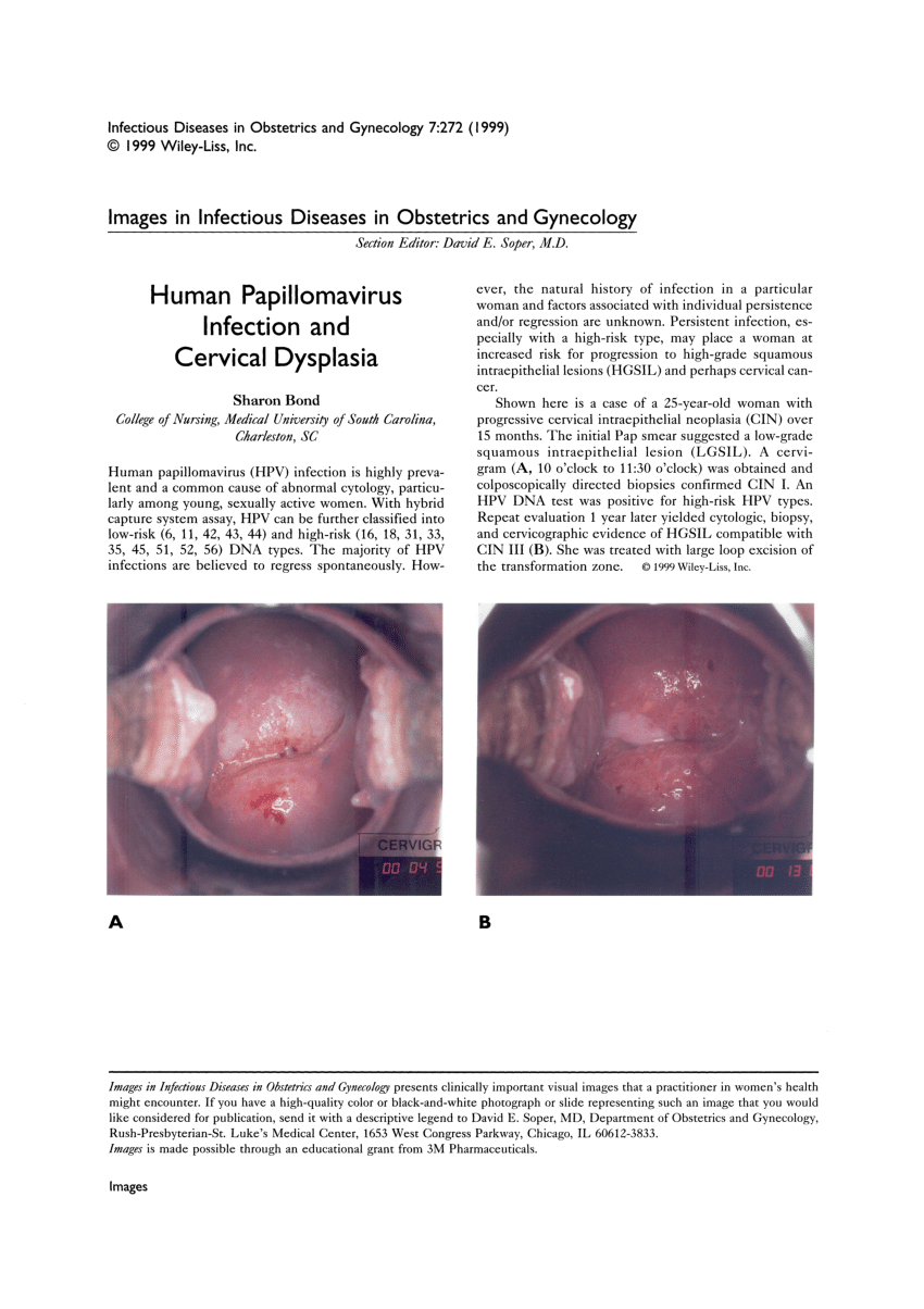 îndepărtați condiloamele în locuri intime intraductal papilloma left icd 10