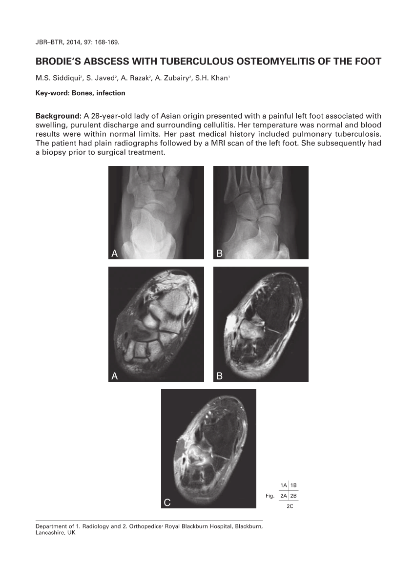 PDF Brodie s abscess with tuberculous osteomyelitis of the foot