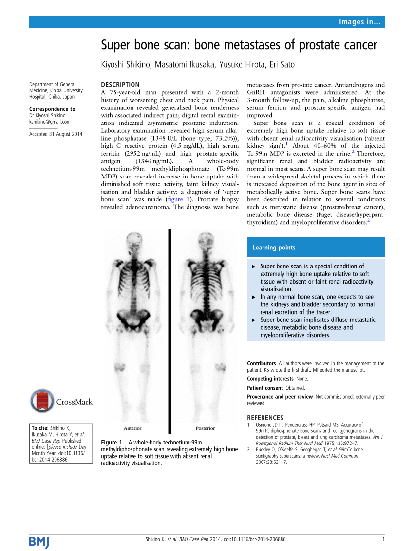 Pdf Super Bone Scan Bone Metastases Of Prostate Cancer 2932