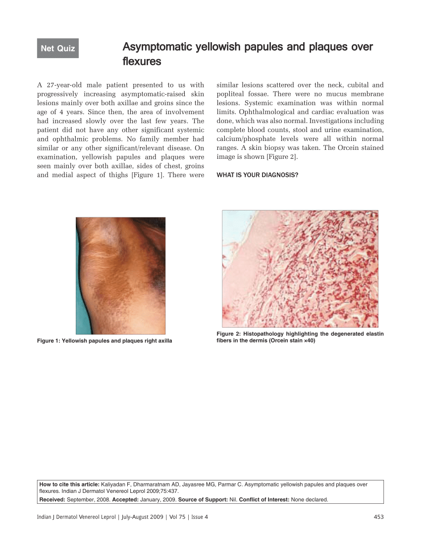 Pdf Asymptomatic Yellowish Papules And Plaques Over Flexures