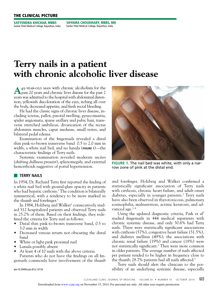 Pdf Terry Nails In A Patient With Chronic Alcoholic Liver Disease