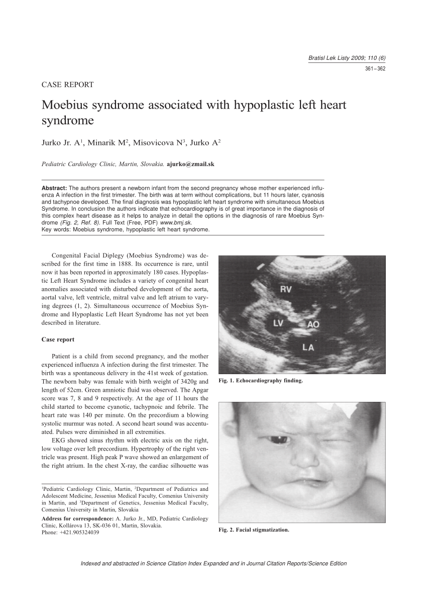 PDF Moebius syndrome associated with hypoplastic left heart syndrome