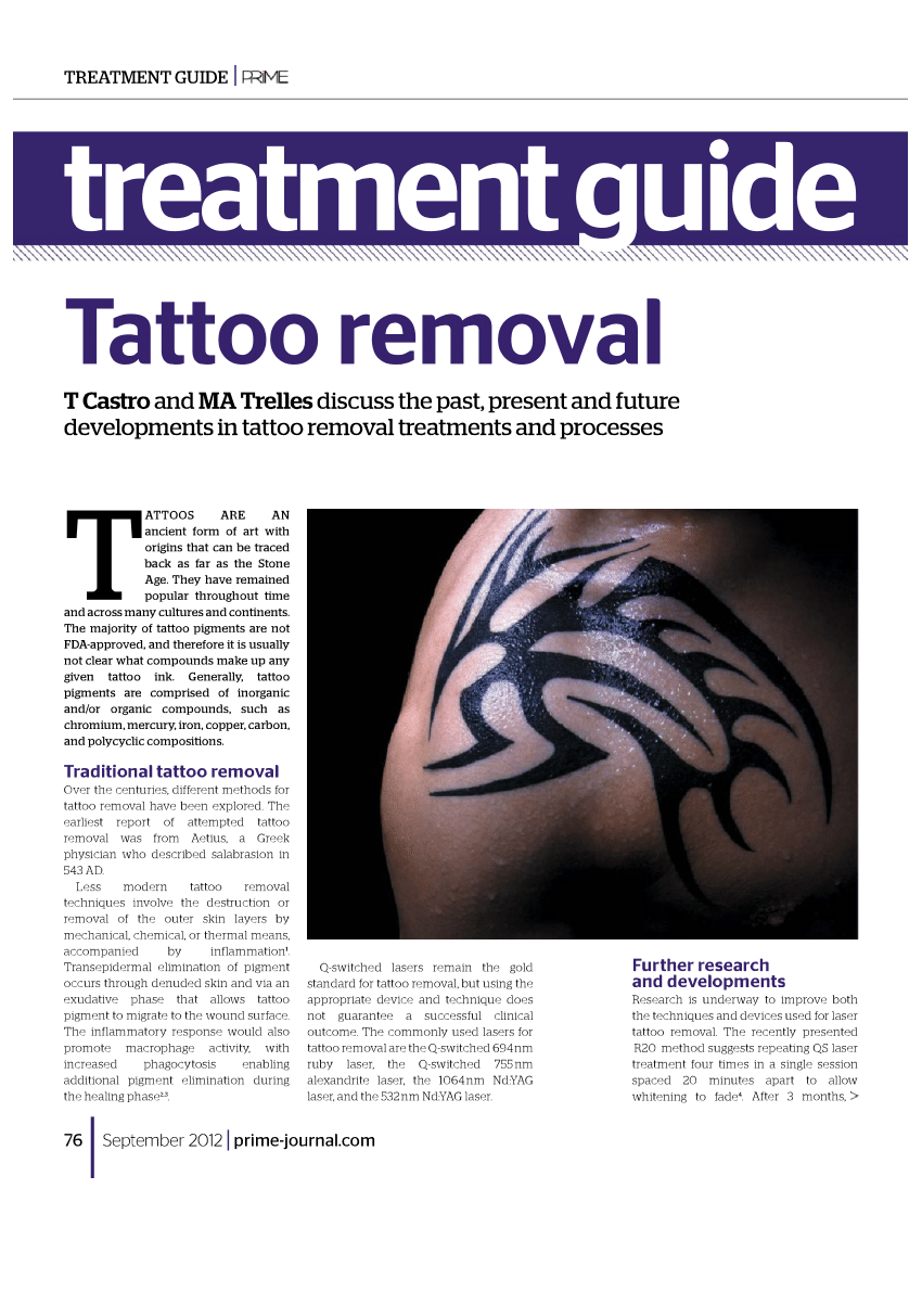 Say goodbye to unwanted tattoos with our laser removal