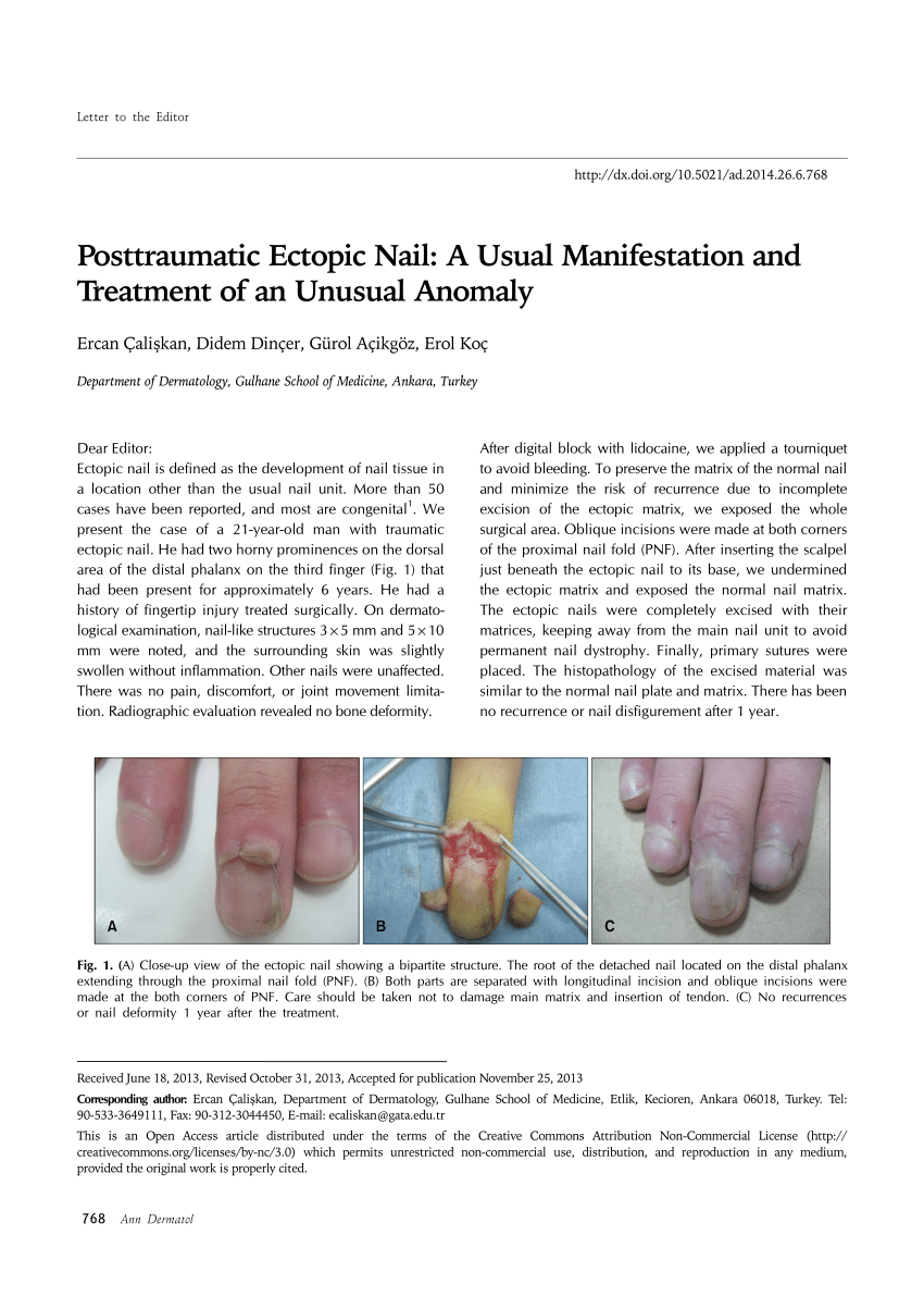 Above) Partial fingernail defect after trauma. (Center) Excision of... |  Download Scientific Diagram