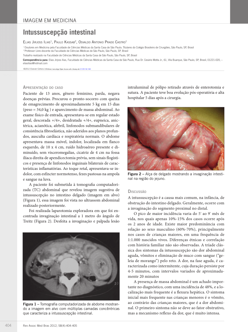 PDF) Tratamento conservador de intussuscepção colônica no adulto