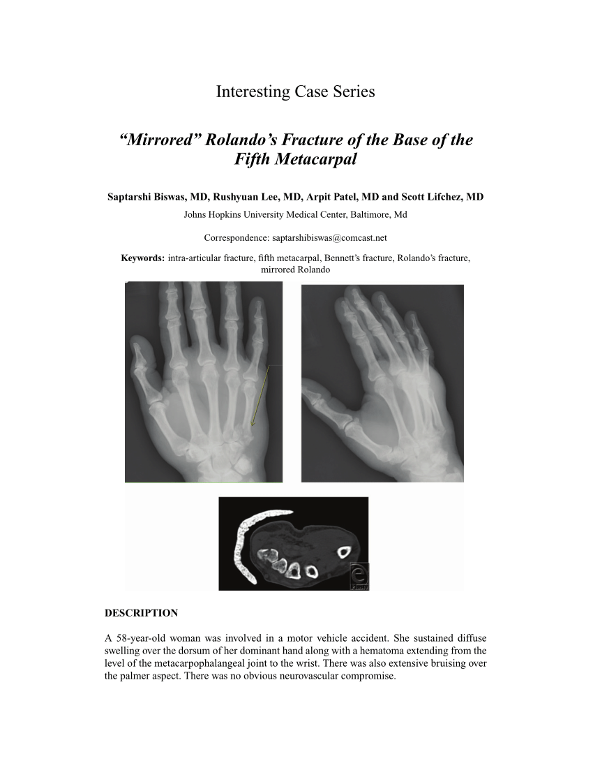 Pdf “mirrored” Rolandos Fracture Of The Base Of The Fifth Metacarpal