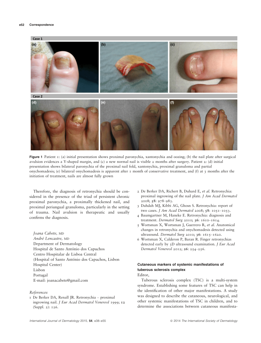 The Adult Phenotype of Tuberous Sclerosis Complex | HTML | Acta  Dermato-Venereologica
