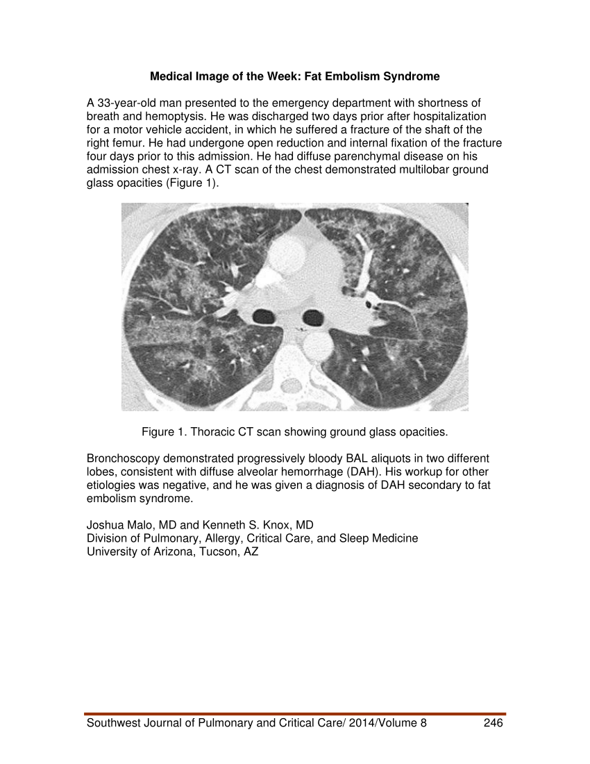 Pdf Medical Image Of The Week Fat Embolism Syndrome 