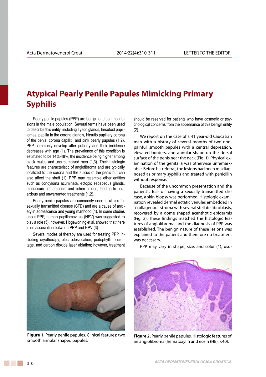 Shaft penile treatment on papules Lymphocele on