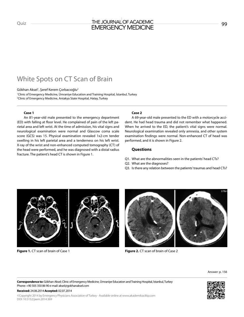 pdf-white-spots-on-ct-scan-of-brain