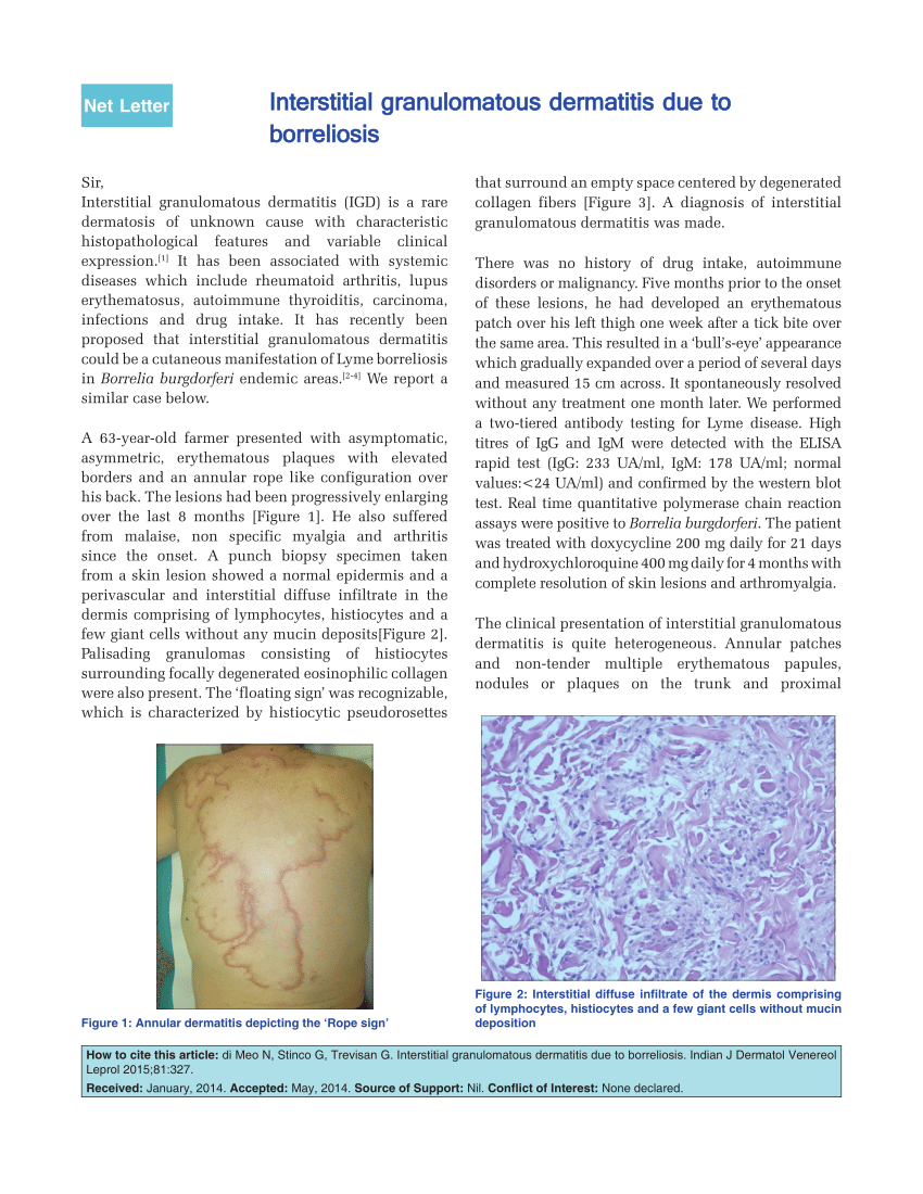 Pdf Interstitial Granulomatous Dermatitis Due To Borreliosis