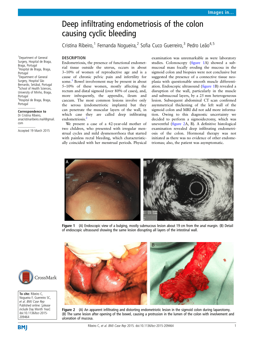 PDF) Deep infiltrating endometriosis of the colon causing cyclic