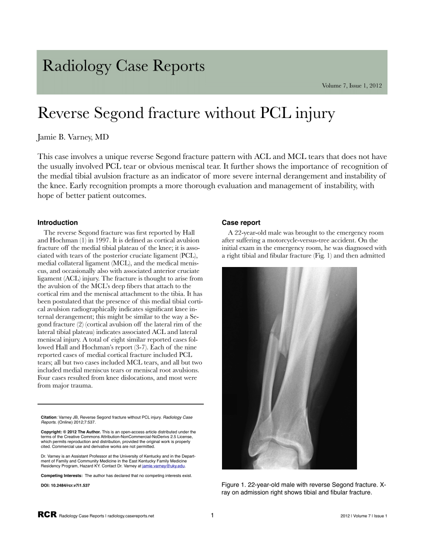 Pdf Reverse Segond Fracture Without Pcl Injury A Case Report