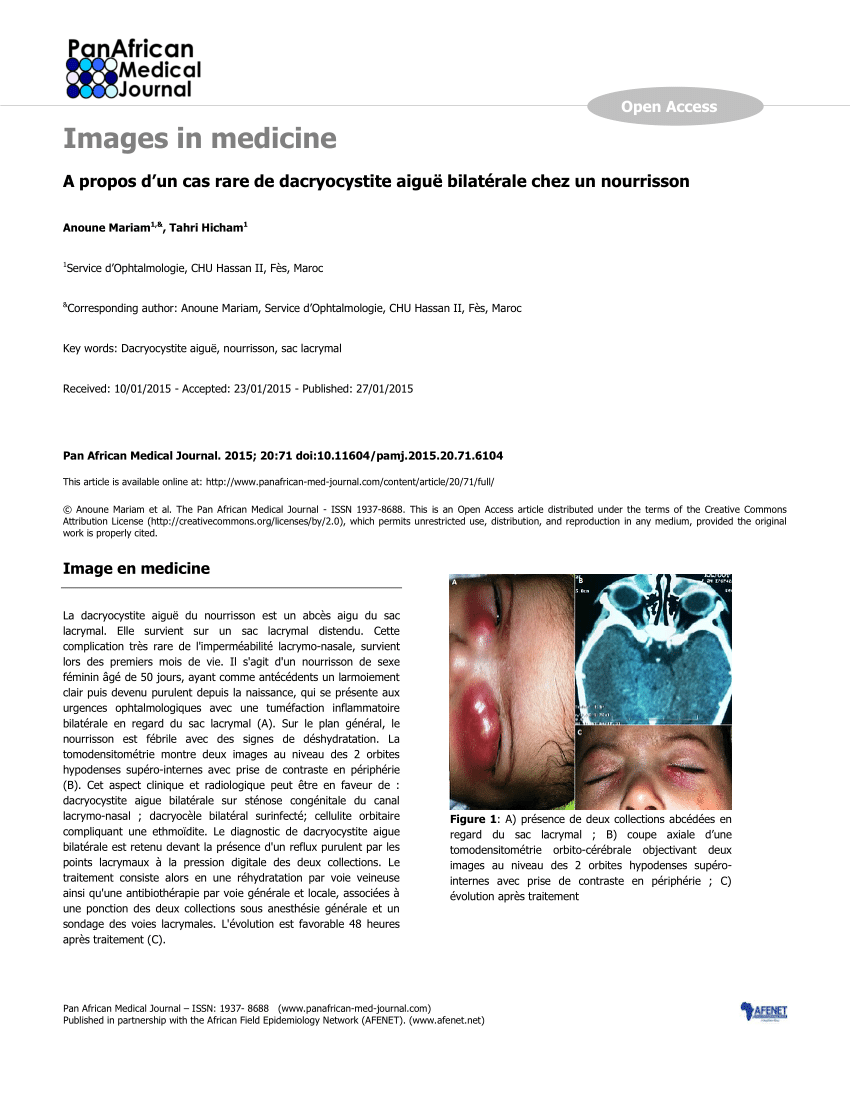 Pdf A Propos D Un Cas Rare De Dacryocystite Aigue Bilaterale Chez Un Nourrisson