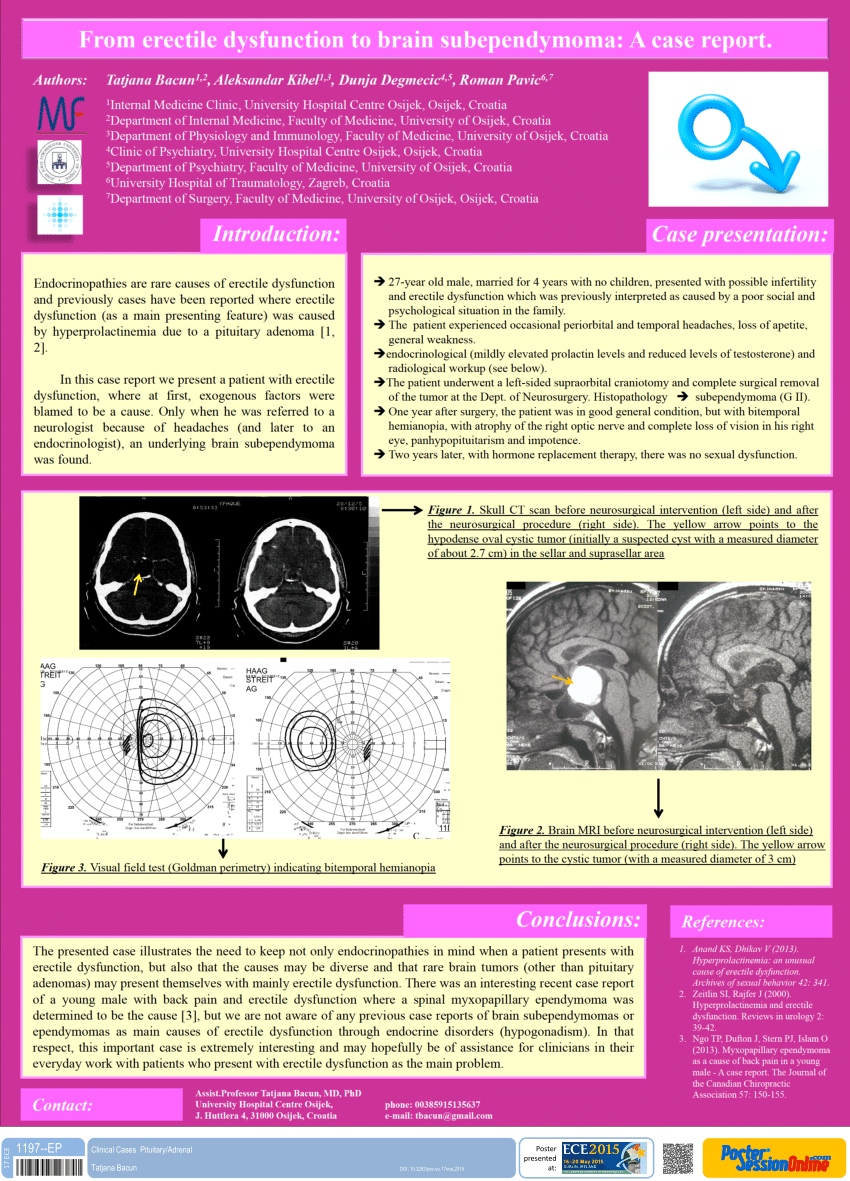 PDF From erectile dysfunction to brain subependymoma a case report