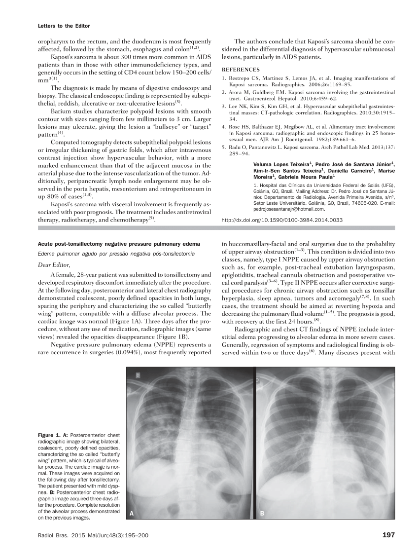 Pdf Acute Post Tonsillectomy Negative Pressure Pulmonary Edema