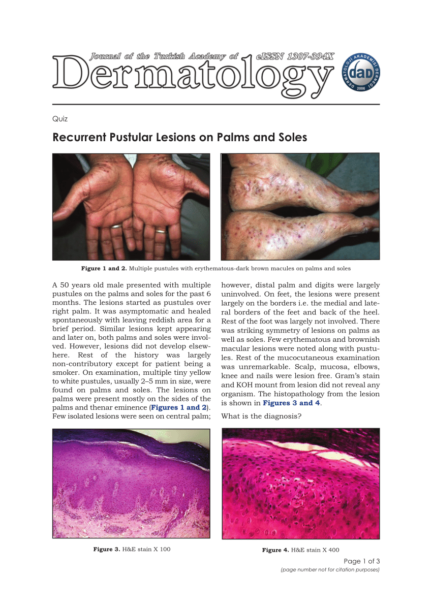 palmoplantar pustulosis histology)