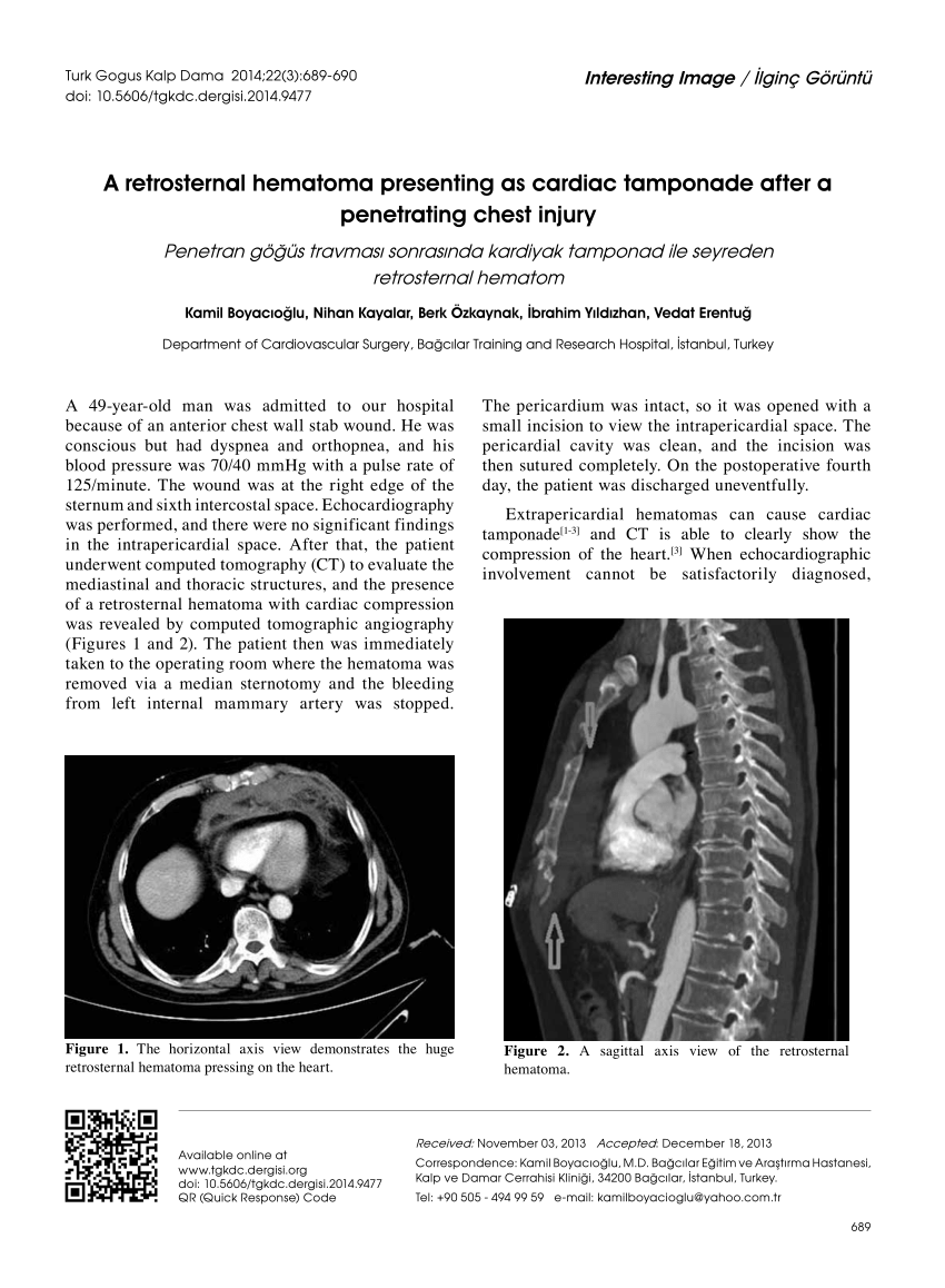 pdf a retrosternal hematoma presenting as cardiac tamponade after a penetrating chest injury