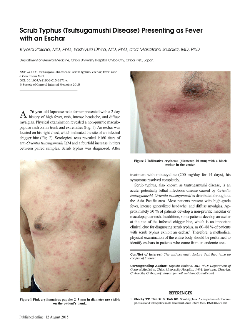 PDF) Scrub Typhus (Tsutsugamushi Disease) Presenting as Fever with 