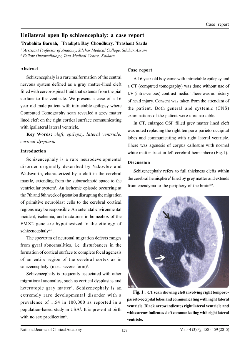 Pdf Unilateral Open Lip Schizencephaly A Case Report