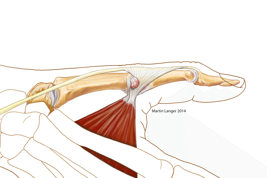 (PDF) Stener´s lesion Thumb ulnar collateral ligament