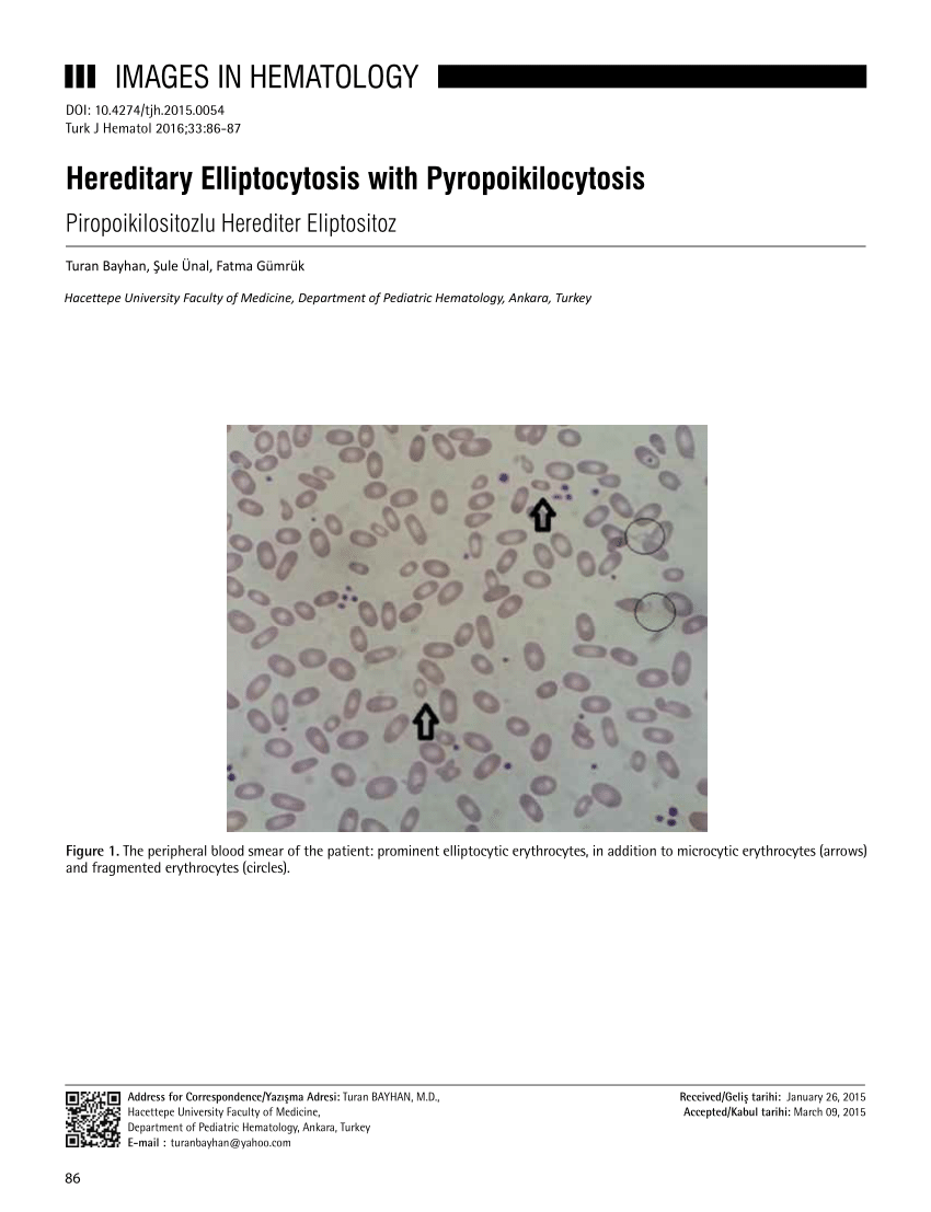 hereditary elliptocytosis case study