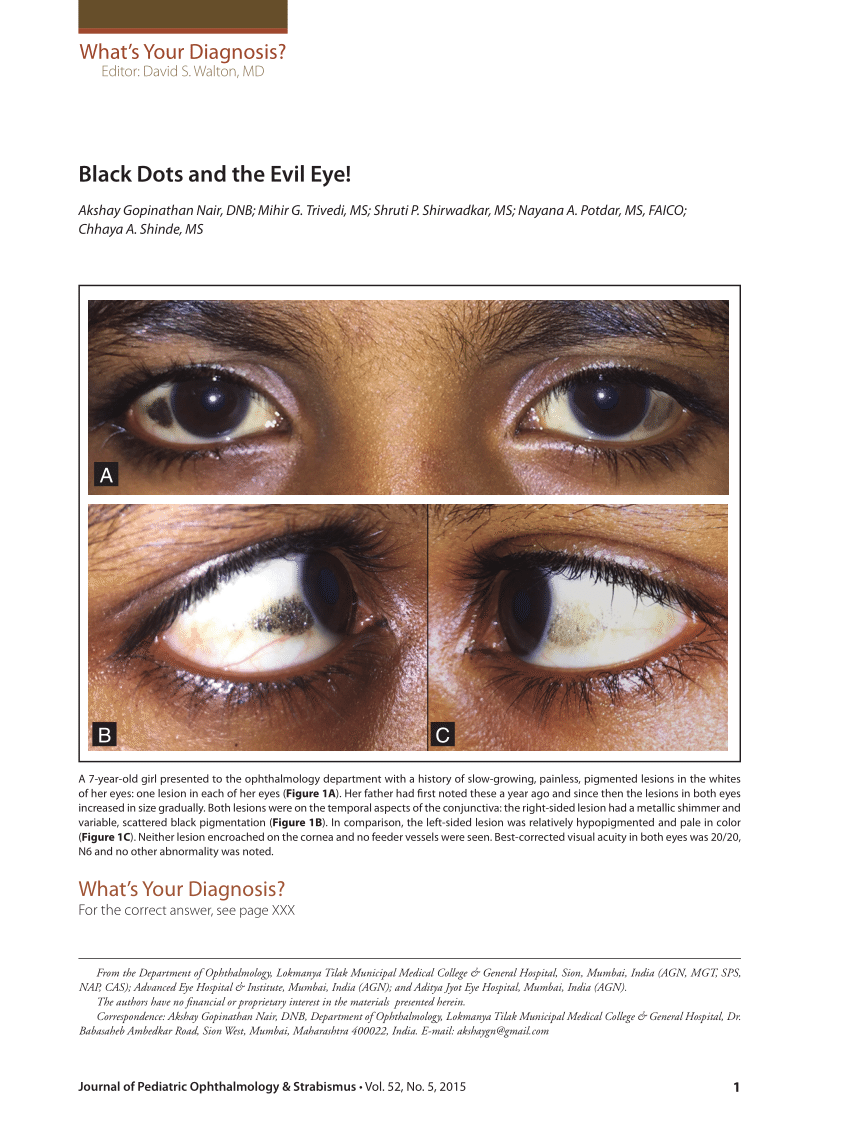 black spot in peripheral vision