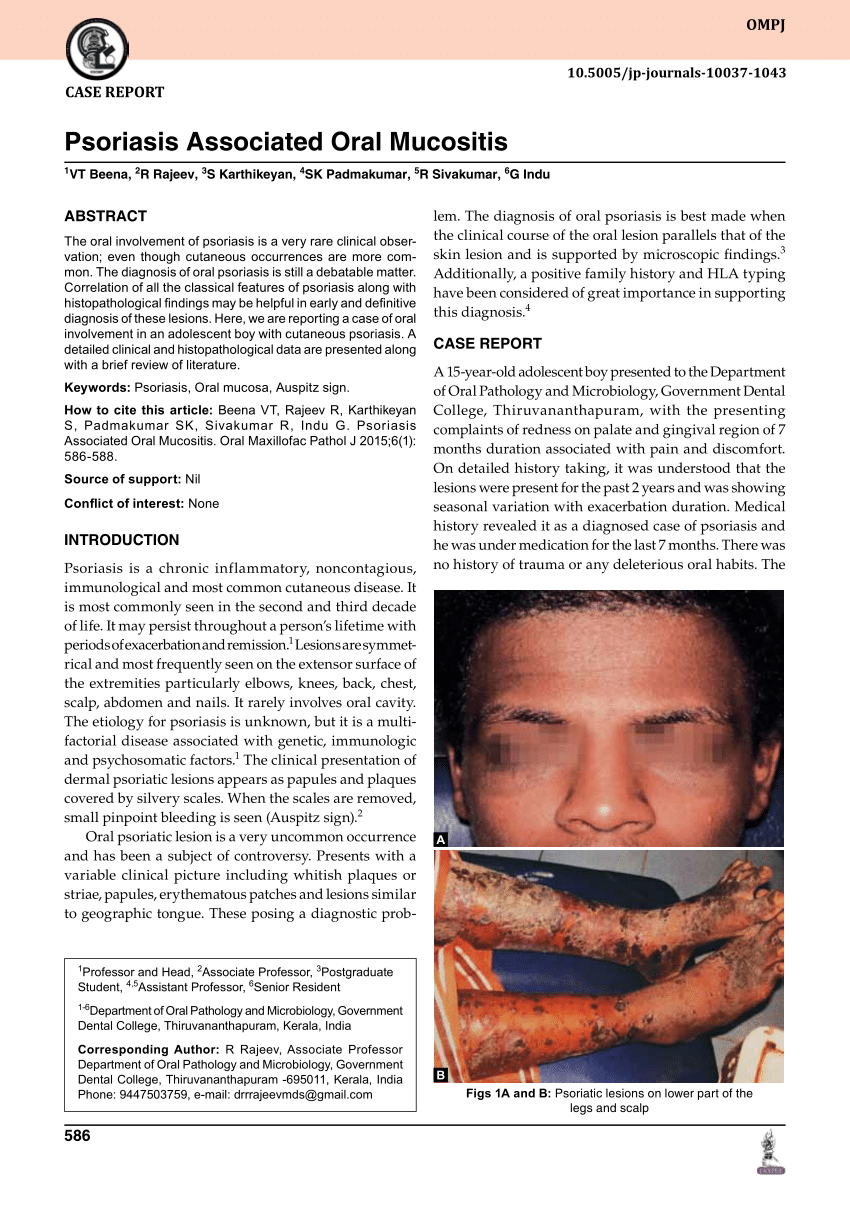 (PDF) Psoriasis Associated Oral Mucositis