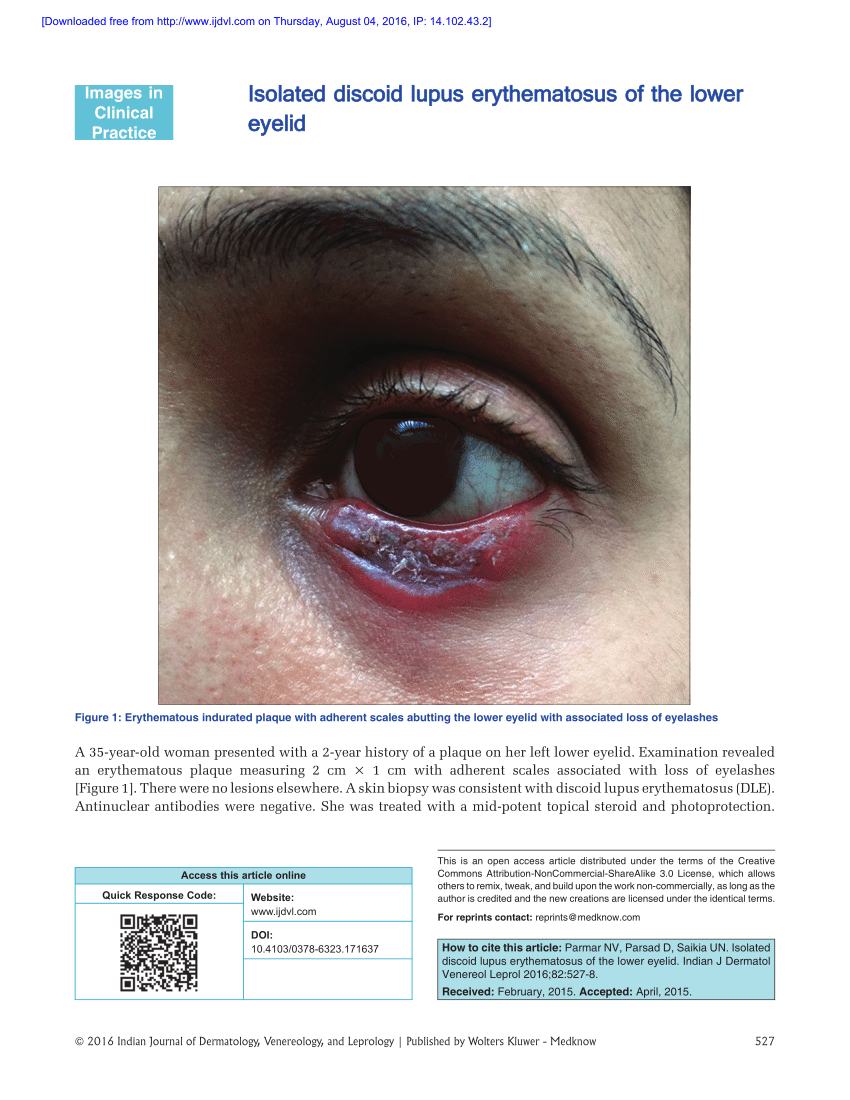 Pdf Isolated Discoid Lupus Erythematosus Of The Lower Eyelid 