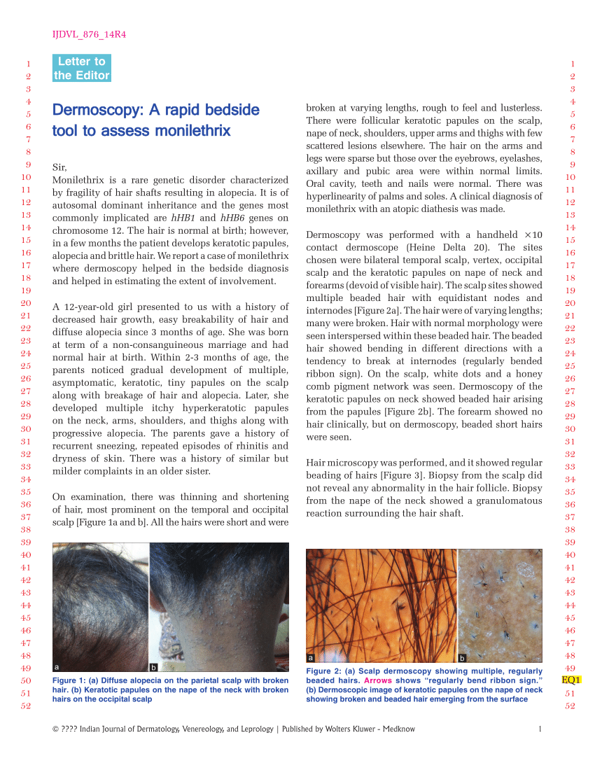 Approach to inherited hypertrichosis: A brief review - Indian Journal of  Dermatology, Venereology and Leprology