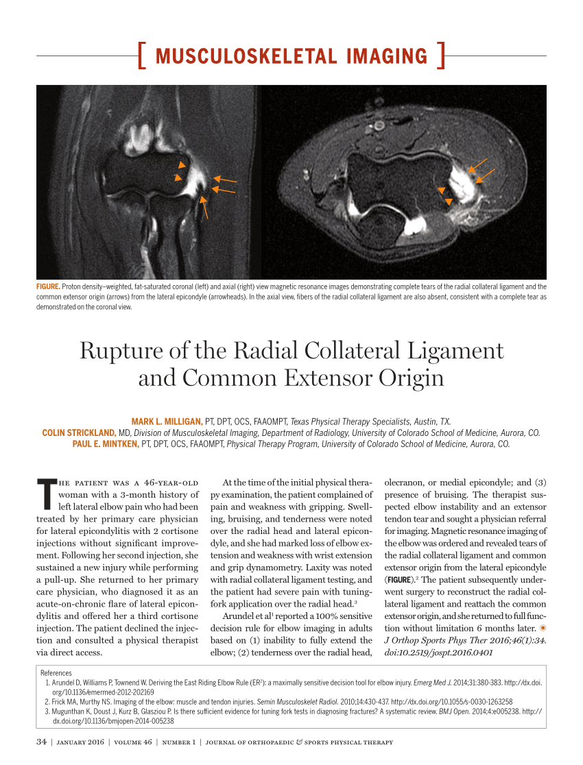 Pdf Rupture Of The Radial Collateral Ligament And Common Extensor Origin 3129