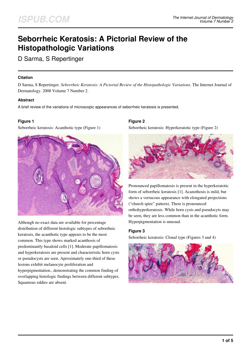 Hyperkeratotic squamous papilloma. Hyperkeratosis papillomatosis and acanthosis