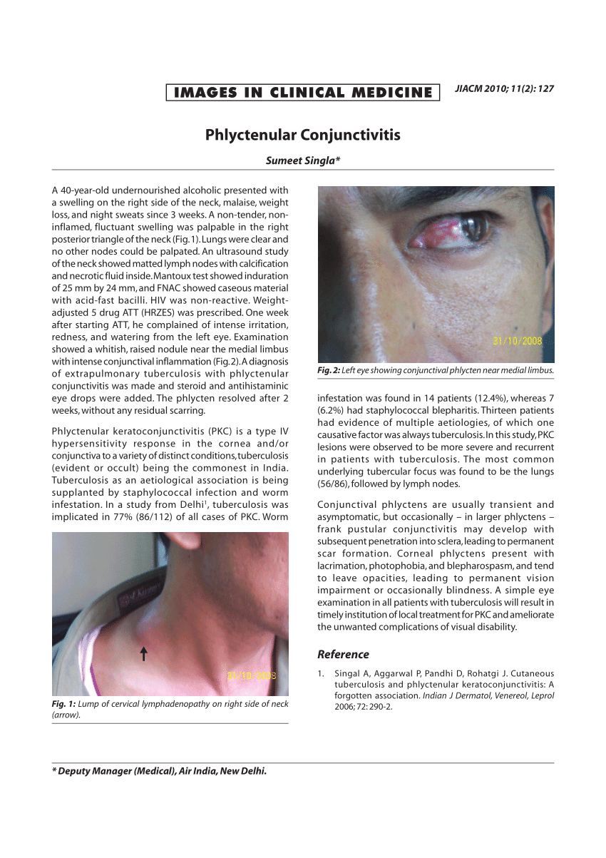 (PDF) Phlyctenular Conjunctivitis