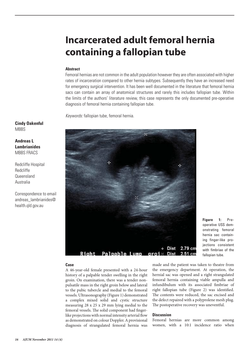 Pdf Incarcerated Adult Femoral Hernia Containing A Fallopian Tube