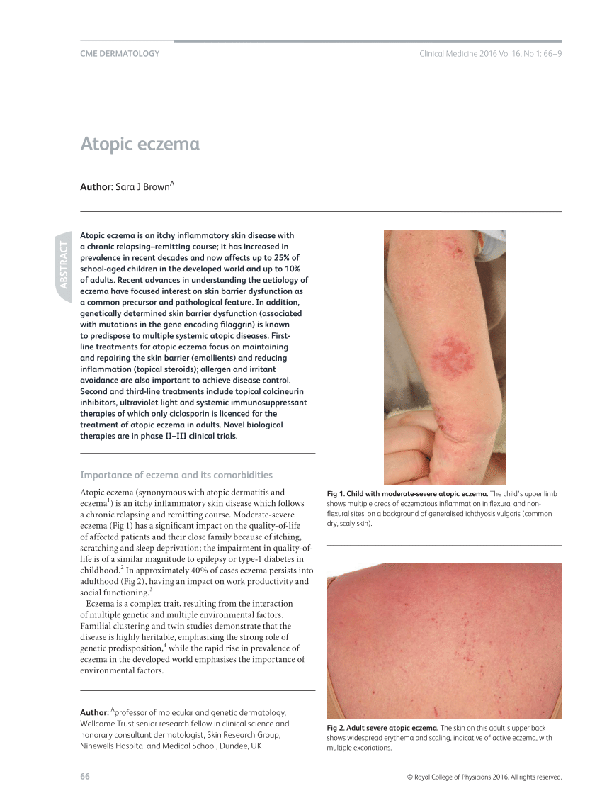 eczema pdf