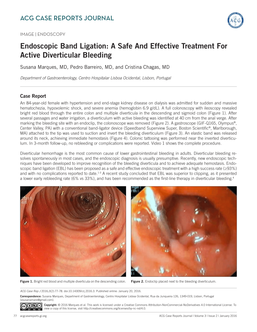 Pdf Endoscopic Band Ligation A Safe And Effective Treatment For Active Diverticular Bleeding