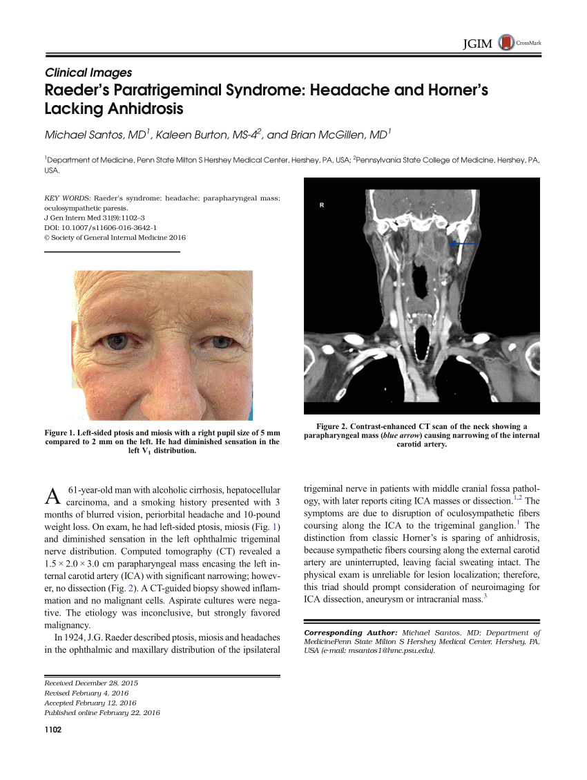 PDF Raeder s Paratrigeminal Syndrome Headache and Horner s