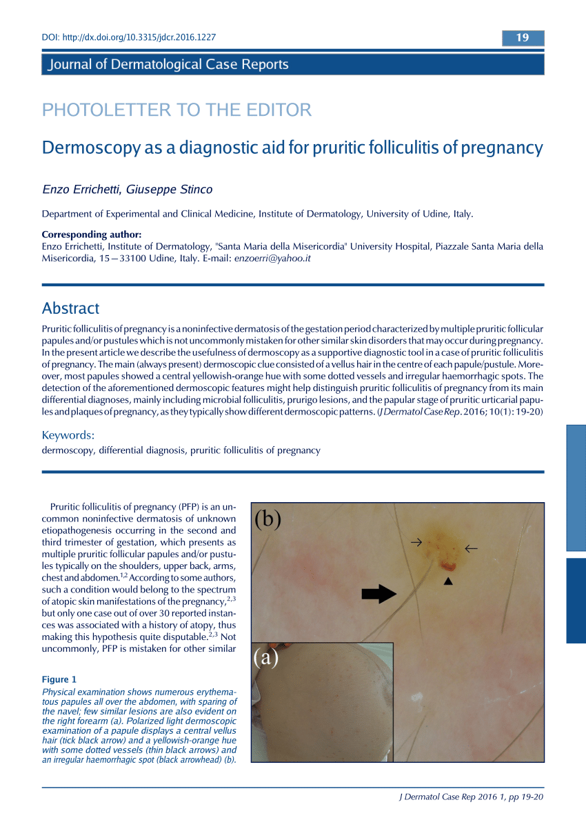 Pdf Dermoscopy As A Diagnostic Aid For Pruritic Folliculitis Of Pregnancy 5780